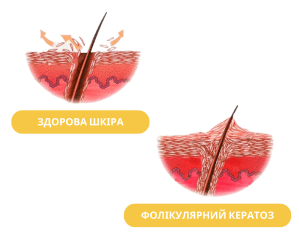 Здорова шкіра - фолікулярний кератоз