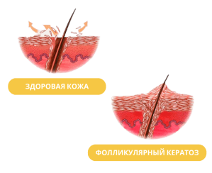 Здоровая кожа - фолликулярный кератоз
