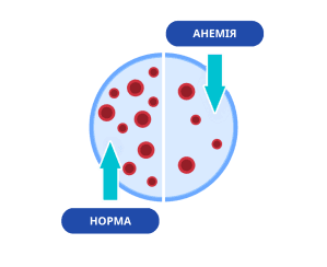 Як виглядає залізодефіцитна анемія: порівняння нормального стану і кількості еритроцитів у крові при анемії