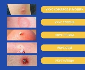 Укусы насекомых